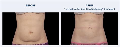 CoolSculpting Downtown San Francisco Fat Reduction and Body Contouring | Michael Echavez MD