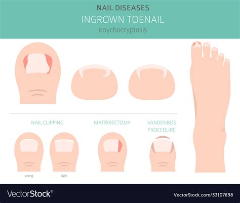 Toenail regrowth process: Does a Cracked Toenail Grow Back? Explained