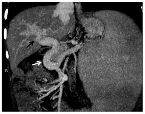 Diagnostics | Free Full-Text | The Role of Imaging in Portal Vein ...