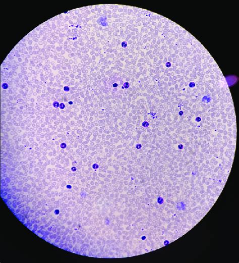 Peripheral blood smear (×100; oil immersion) showing normocytic ...