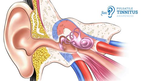 Pulsatile Tinnitus Causes & Treatments