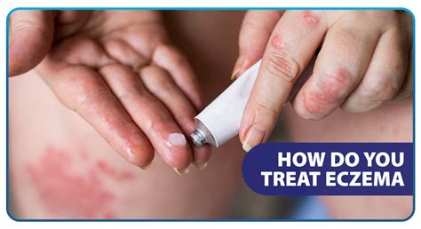 How Do You Treat Eczema - Unilab