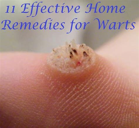 infected plantar wart - pictures, photos