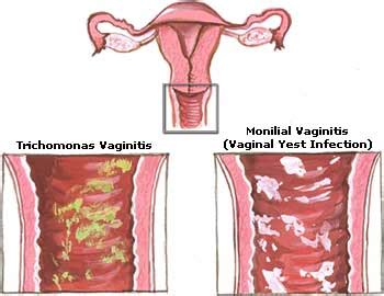 Home Remedies for Yeast Infection: Causes, Symptoms, Treatment & Diet