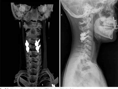 Figure 4 from C3-C4 Unilateral Facet Fracture Dislocation with Vertebral Artery Injury in an ...