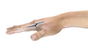 Artificial Finger Joint Replacement | Advanced Orthopaedics & Sports Medicine, Orthopaedic ...