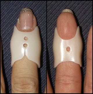 Custom-Made Splint Treatment for Osteoarthritis of the Distal Interphalangeal Joints - Journal ...