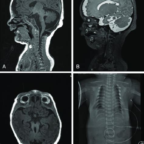 Patient 2 (A-C) Brain MRI showing cortical thickening with simplified... | Download Scientific ...