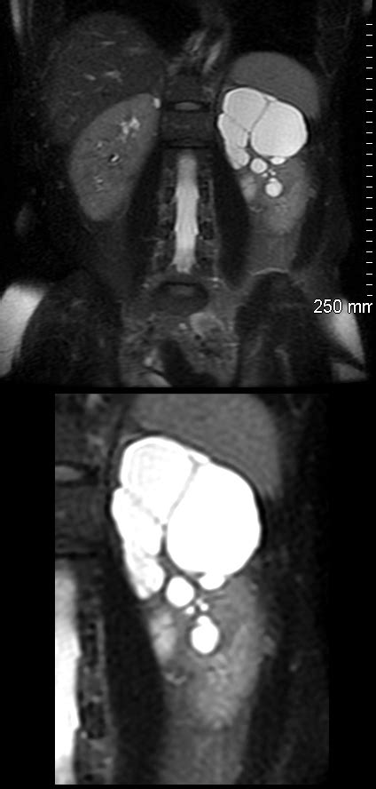 IF Finding Cyst Septated MRI | Kidney