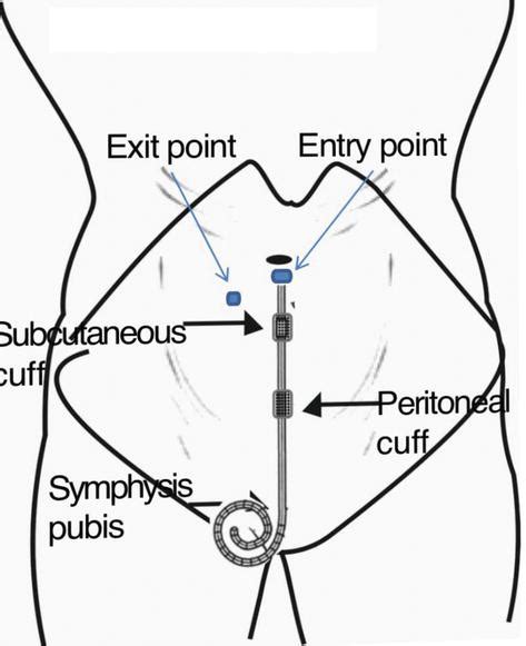 Peritoneal Drain Placement - Best Drain Photos Primagem.Org