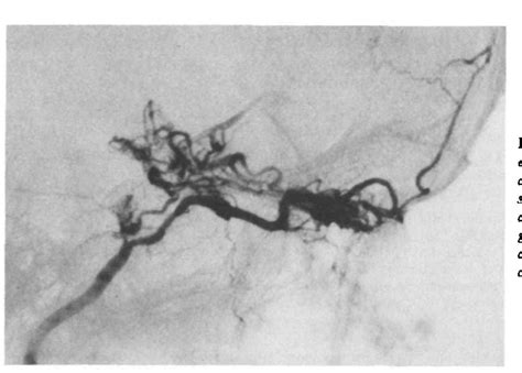 Figure 1 from Lipohyalinosis and Miliary Microaneurysms Causing Cerebral Hemorrhage in a Patient ...