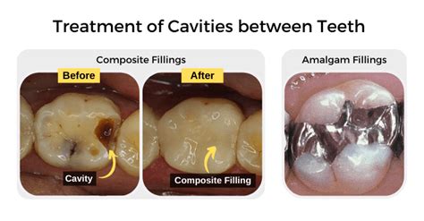 Cavities Between Teeth: How To Spot, Treat, & Prevent - Share Dental Care