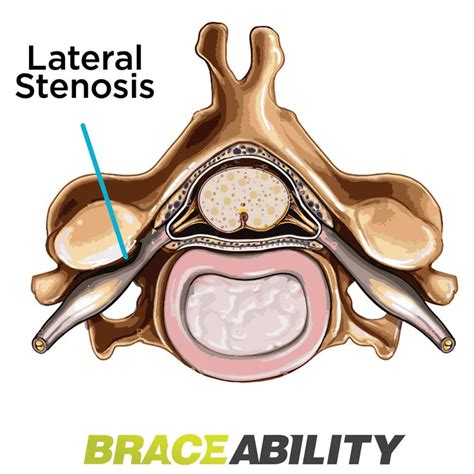 Pin on Back Injuries & Spine Disorders | What's Causing my Back Pain? Lower, Middle, & Upper ...