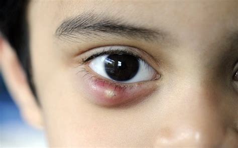 How Much Does Chalazion Surgery Cost?