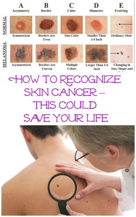 How To Recognize Skin Cancer This Could Save Your Life | Health tips ...