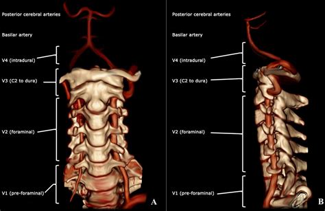 Vertebral Artery Injury in the Cervical Spine: Anatomy, Diag... : JBJS Reviews