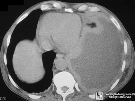 LearningRadiology - Mesothelioma, radiology, malignant, imaging, x-ray, asbestosis