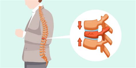 Spinal Compression Fractures: Causes, Symptoms, Treatment and ...