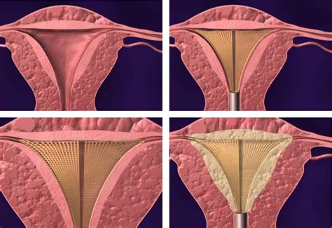 Endometrial ablation