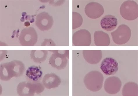 Malaria Smear Stain