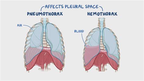 Pneumothorax and hemothorax: Nursing - Osmosis Video Library