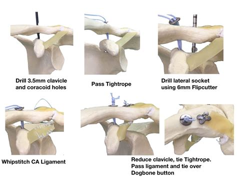 Acromioclavicular Joint Stabilisation DELAYED (CHRONIC) | St. George's Shoulder Unit