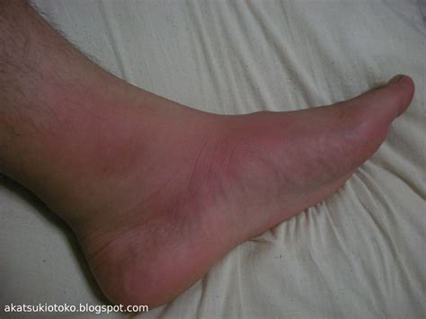 Gout on ankle | akatsukiotoko | Flickr