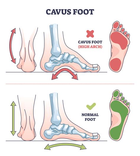 Cavovarus Reconstruction/High Arch Surgery - Perth Orthopaedic Specialist Centre