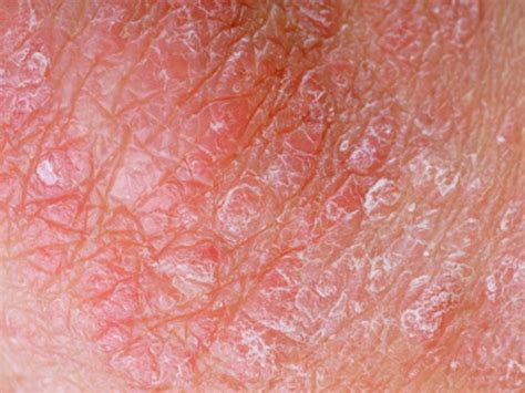 Men More Prone to Severe Psoriasis: Study