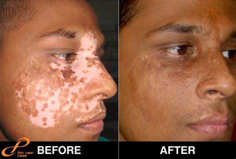 White Patches or Vitiligo is Common, But After Sometimes it Make Part of The Big Problem. The ...