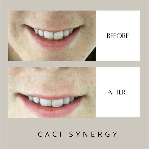 CACI NON-SURGICAL FACE LIFTS - BODY BASIX SKIN CLINIC