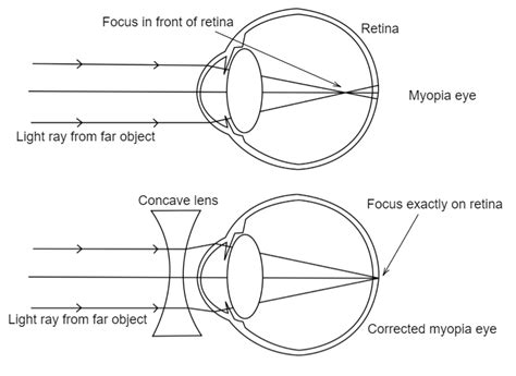 Draw ray diagrams each showing (i) myopic eye and (ii) hypermetropic eye.