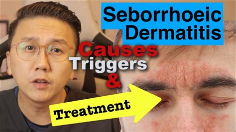 Seborrhoeic Dermatitis - Causes, Triggers & Treatment Options - YouTube