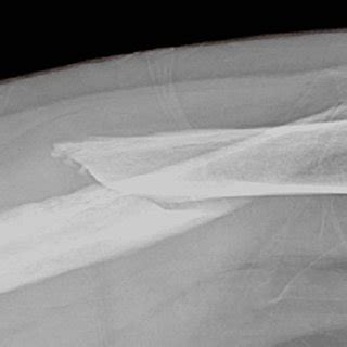 Femur x-ray showing the distal displaced femoral fracture (view 1 ...