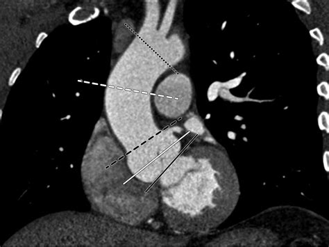 CT and MRI Assessment of the Aortic Root and Ascending Aorta | AJR