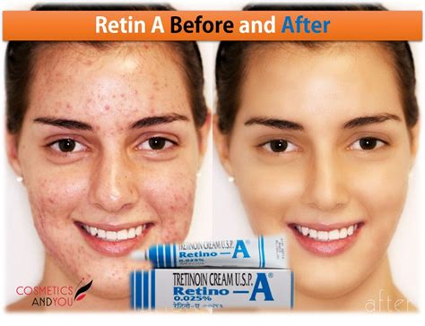 Retin A Before and After – Cosmetics and you : Acne Treatment, Careprost Eyelashes, Careprost ...