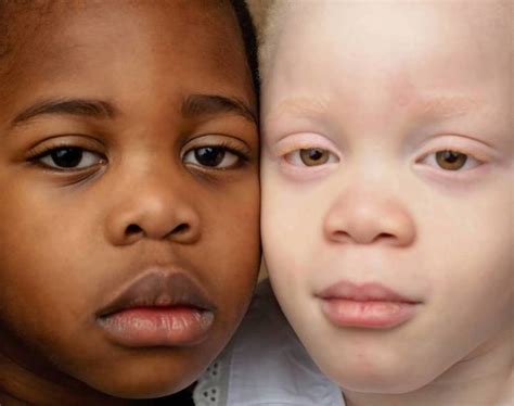 These Twins Have Different Skin Colors! (15 pics) - Izismile.com