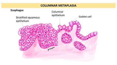 Metaplasia: Types and Causes - Pathology Made Simple