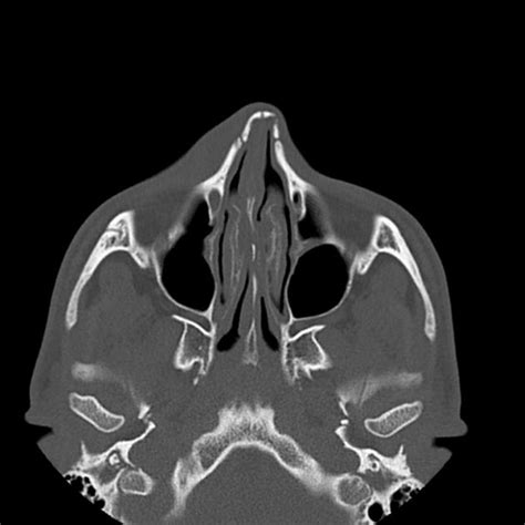 Nasal bone fracture | Radiology Case | Radiopaedia.org | Bone fracture ...