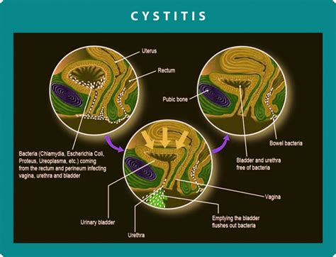 Chronic Cystitis - Diagnosis and Symtoms | Georgiadis Urology