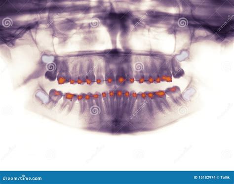 X-ray Of Orthodontic Braces Stock Photo - Image of anatomy, braces: 15182974