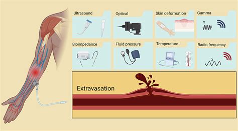 Iv Infiltration Signs