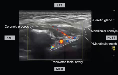 Ultrasound Guided Maxillary Nerve Block Via The Pterygopalatine Fossa | Images and Photos finder