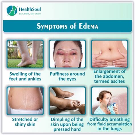 Edema: Cause, Symptoms and Treatment - Healthsoul