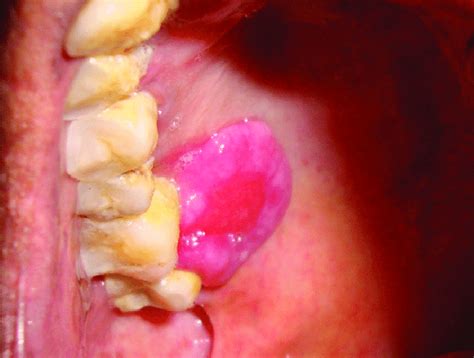 Ten days after the incisional biopsy, the lesion regained its original... | Download Scientific ...