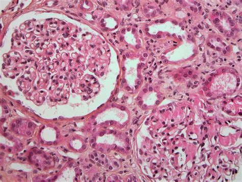 Amyloidosis Histology