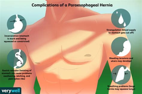 Paraesophageal Hiatal Hernia Complications