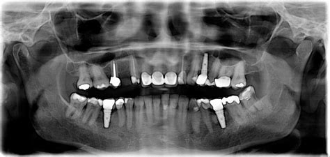 Memphis, TN Tooth Loss Causes - Missing Teeth and Restorative Dentistry