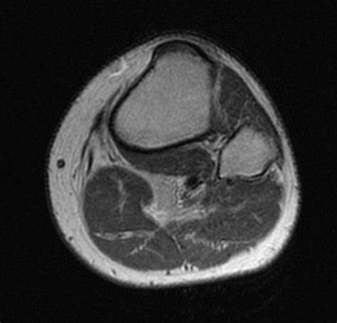 Plantaris muscle or tendon rupture - wikidoc