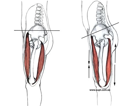 Does Anterior Pelvic Tilt Cause Back Pain - Exercise Right